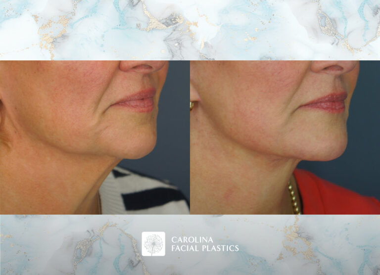 Carolina Facial Plastics before and after | facelift with platysmaplasty by Jonathan Kulbersh MD
