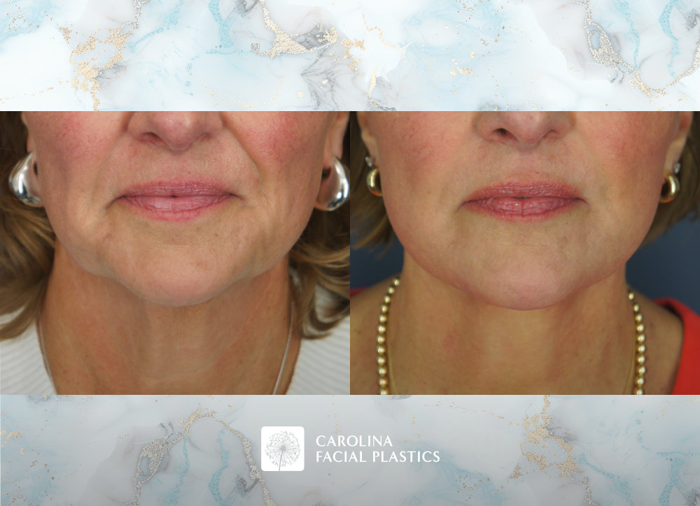 Carolina Facial Plastics before and after | facelift with platysmaplasty by Jonathan Kulbersh MD