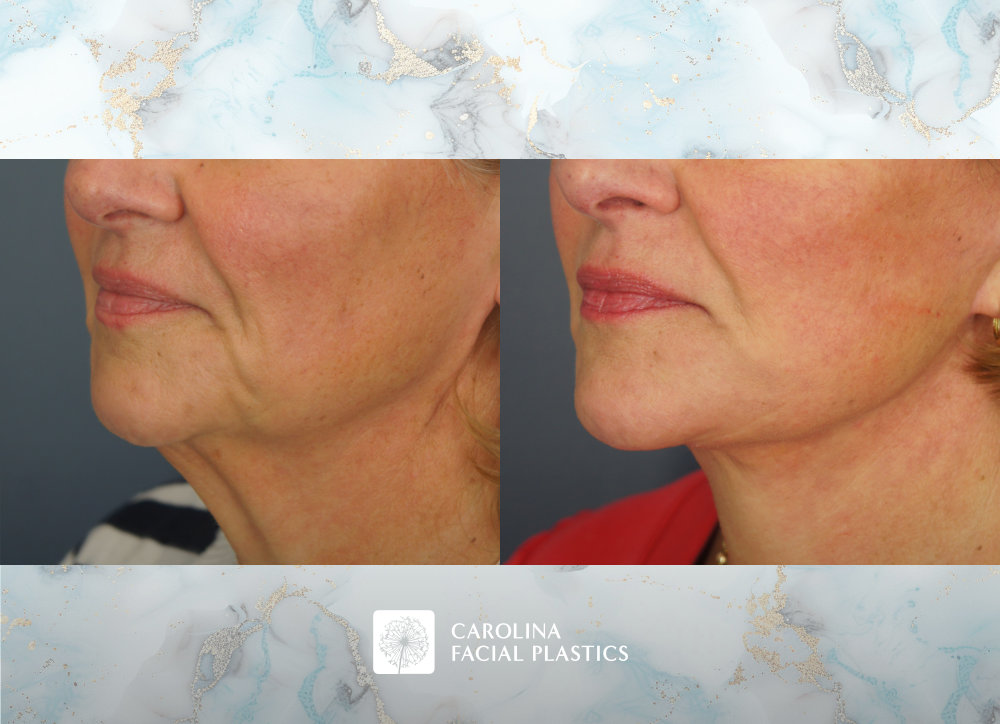 Carolina Facial Plastics before and after | facelift with platysmaplasty by Jonathan Kulbersh MD