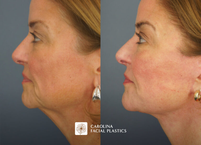 facelift before and after