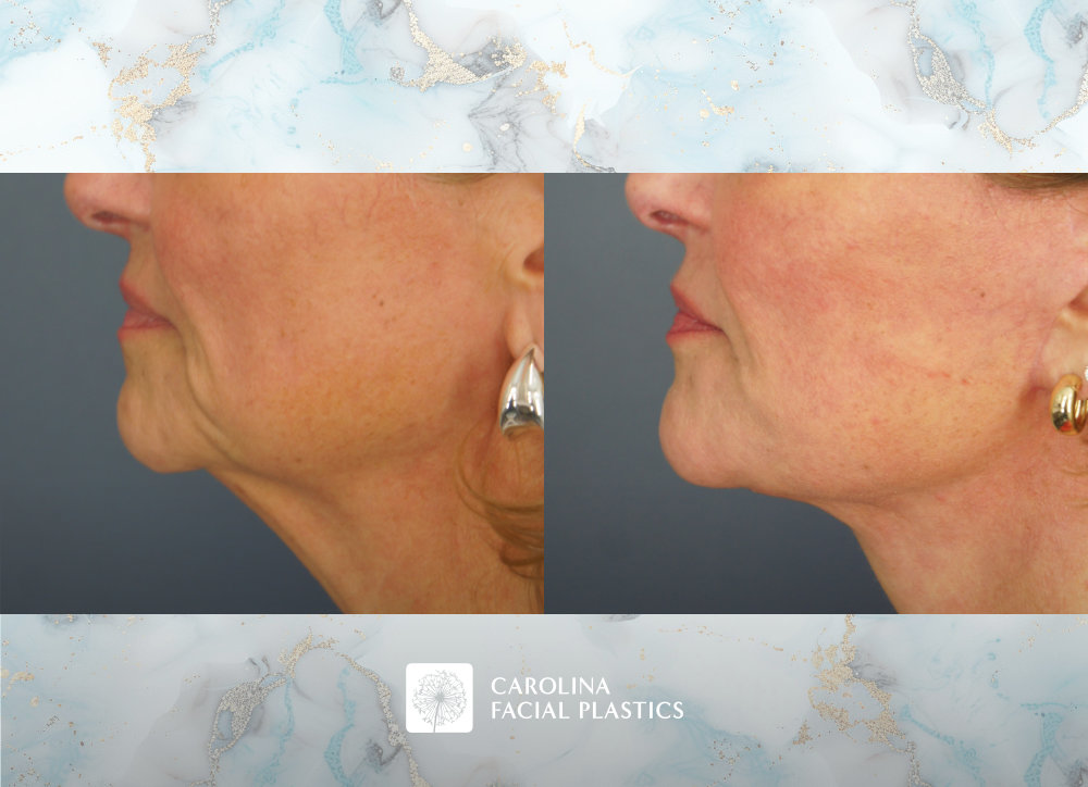 Carolina Facial Plastics before and after | facelift with platysmaplasty by Jonathan Kulbersh MD