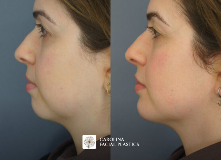 before and after neck liposuction