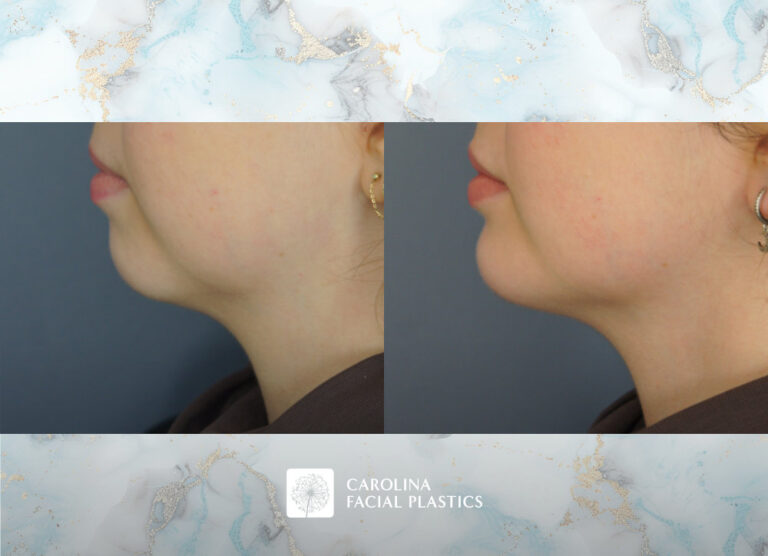 Carolina Facial Plastics before and after | chin implant and neck liposuction by Jonathan Kulbersh MD