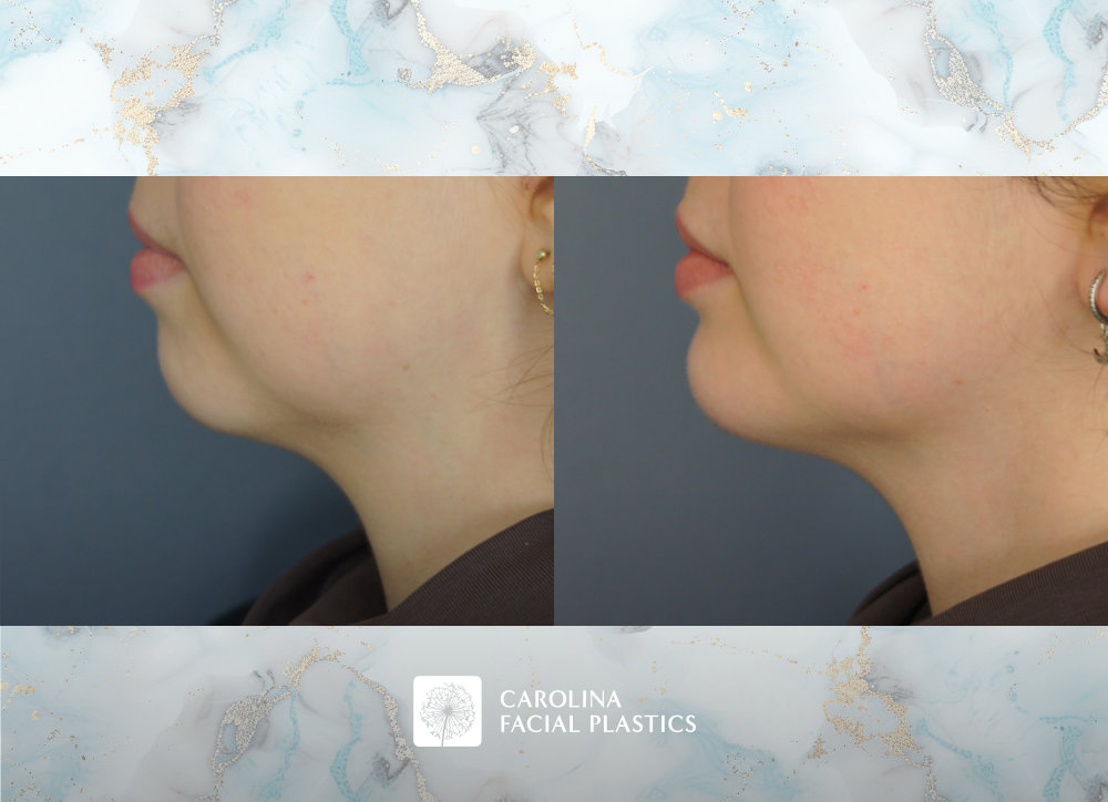 Carolina Facial Plastics before and after | chin implant and neck liposuction by Jonathan Kulbersh MD