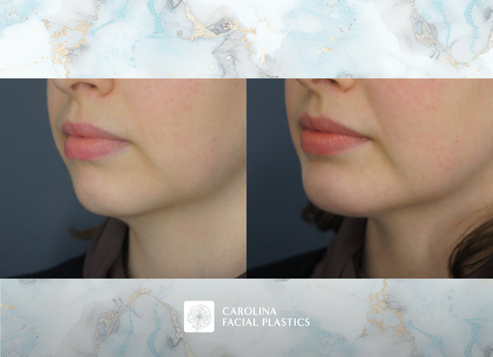 Carolina Facial Plastics before and after | chin implant and neck liposuction by Jonathan Kulbersh MD