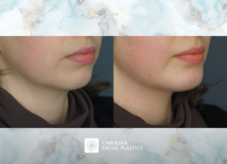 chin implant and liposuction before and after