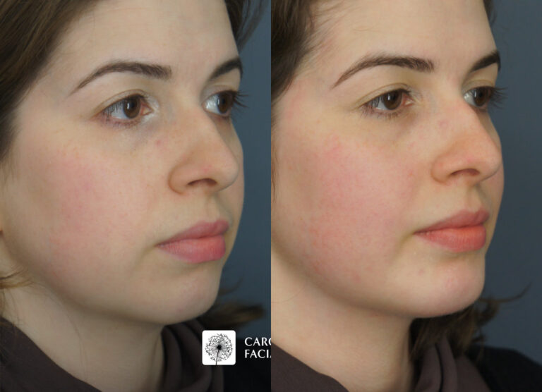 neck liposuction and chin implant before and after