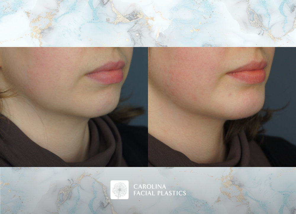 Carolina Facial Plastics before and after | chin implant and neck liposuction by Jonathan Kulbersh MD