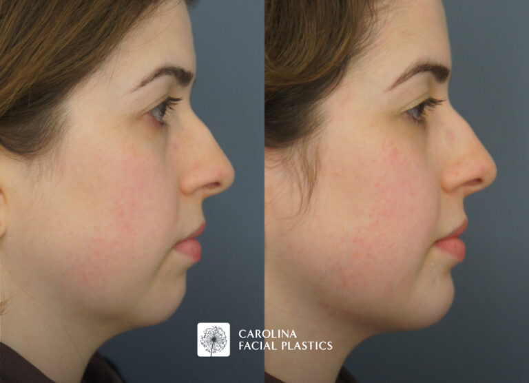 neck liposuction before and after