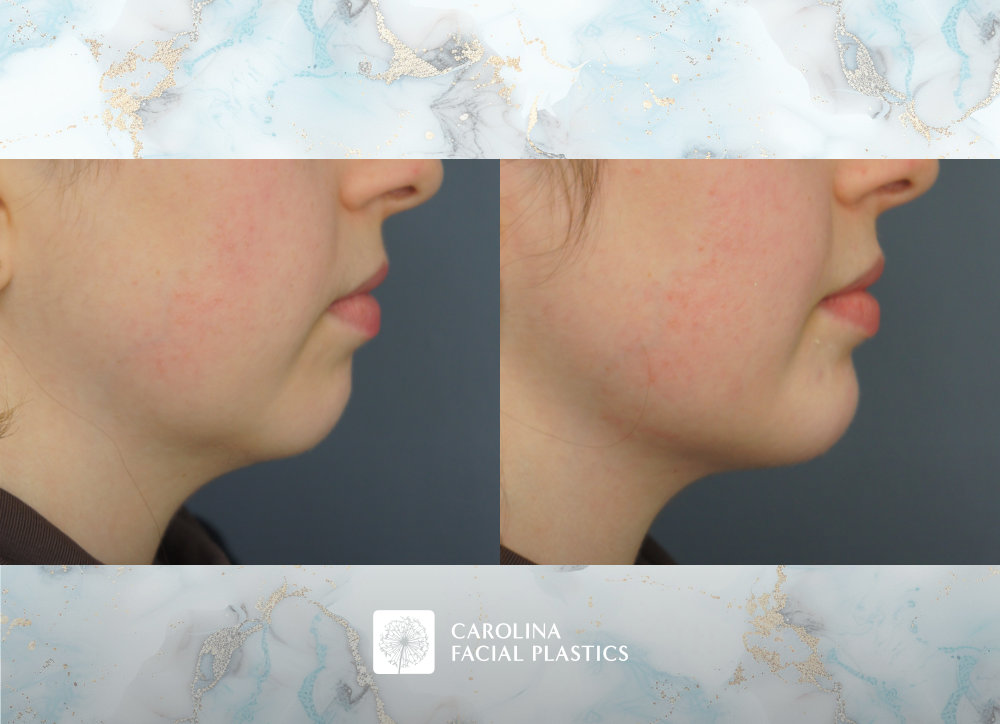 Carolina Facial Plastics before and after | chin implant and neck liposuction by Jonathan Kulbersh MD