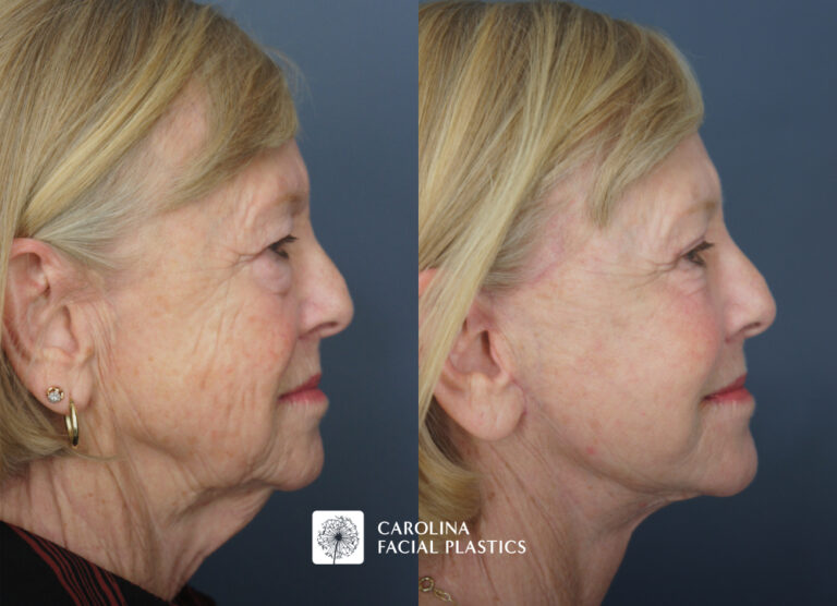 Face and Neck Lift, Quad Blepharoplasty, Facial Fat Grafting, Face C02 Laser by Dr Jonathan Kulbersh | Carolina Facial Plastics