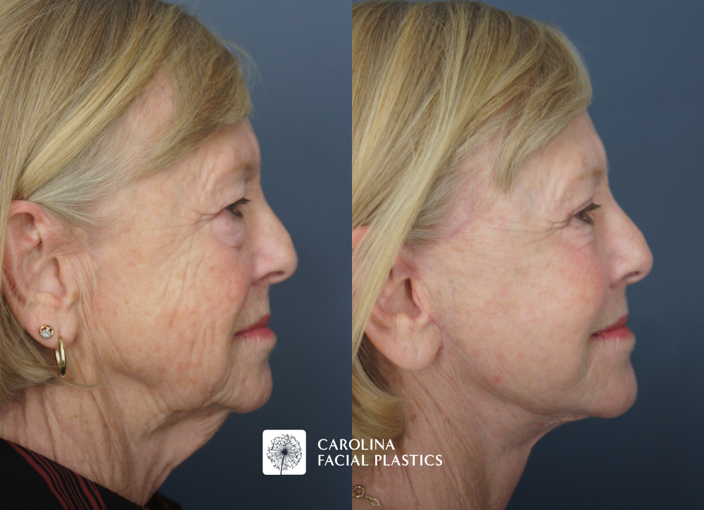 Face and Neck Lift, Quad Blepharoplasty, Facial Fat Grafting, Face C02 Laser by Dr Jonathan Kulbersh | Carolina Facial Plastics