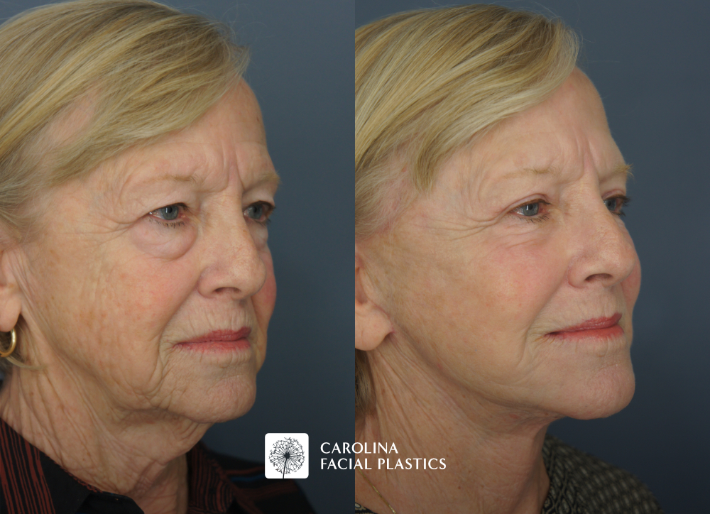 Face and Neck Lift, Quad Blepharoplasty, Facial Fat Grafting, Face C02 Laser by Dr Jonathan Kulbersh | Carolina Facial Plastics
