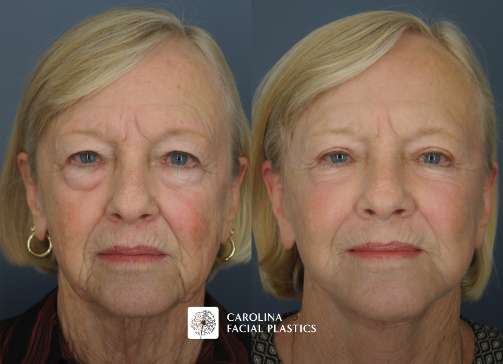 Face and Neck Lift, Quad Blepharoplasty, Facial Fat Grafting, Face C02 Laser by Dr Jonathan Kulbersh | Carolina Facial Plastics