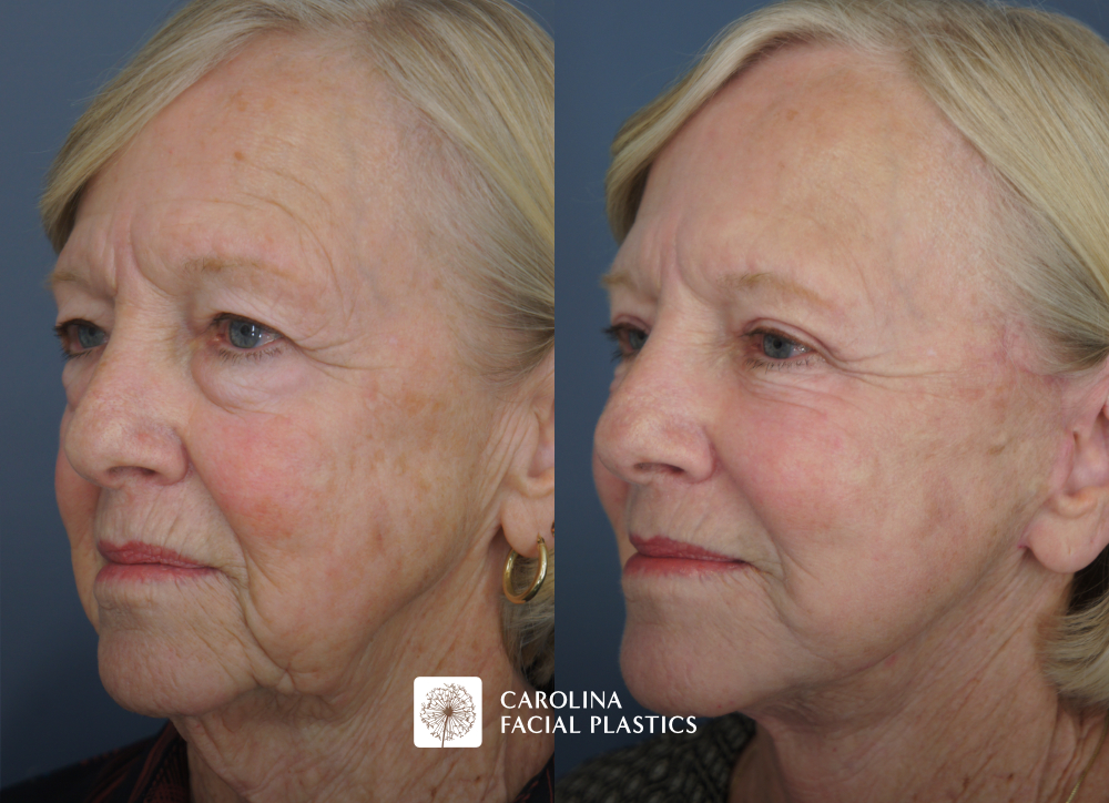 Face and Neck Lift, Quad Blepharoplasty, Facial Fat Grafting, Face C02 Laser by Dr Jonathan Kulbersh | Carolina Facial Plastics