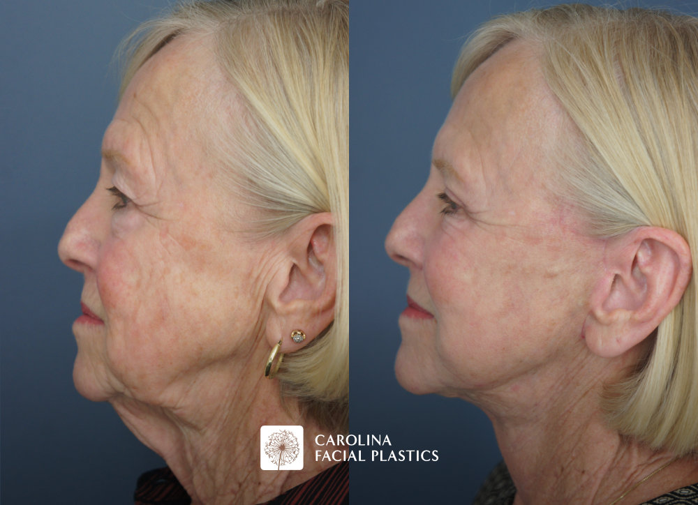 Face and Neck Lift, Quad Blepharoplasty, Facial Fat Grafting, Face C02 Laser by Dr Jonathan Kulbersh | Carolina Facial Plastics