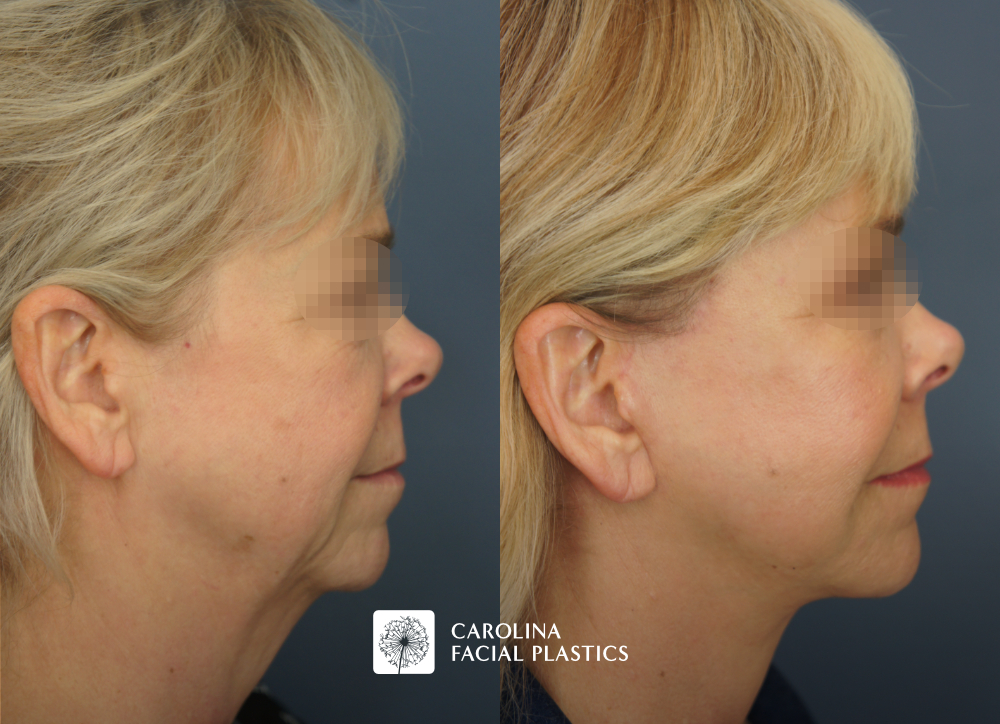 Facelift, Buccal Fat Excision, Lower Blepharoplasty, MLFG to Lower Eyes, CO2 to Lower Eyes, TCA Face by Dr Jonathan Kulbersh | Carolina Facial Plastics