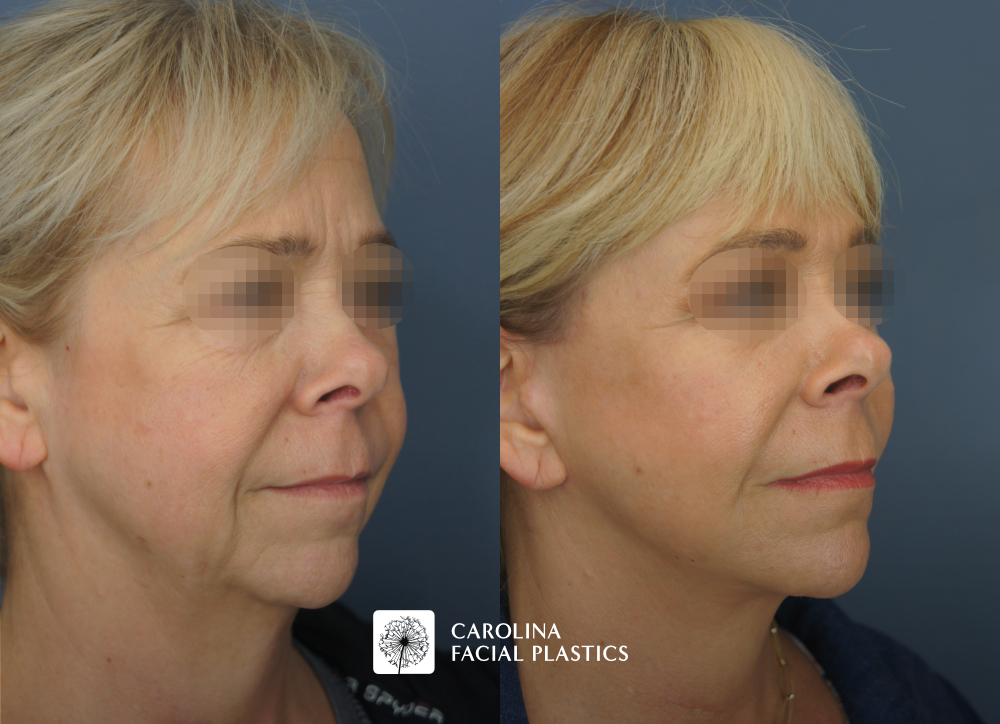 Facelift, Buccal Fat Excision, Lower Blepharoplasty, MLFG to Lower Eyes, CO2 to Lower Eyes, TCA Face by Dr Jonathan Kulbersh | Carolina Facial Plastics