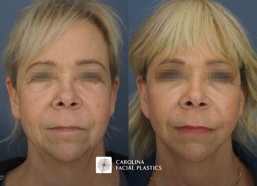 Facelift, Buccal Fat Excision, Lower Blepharoplasty, MLFG to Lower Eyes, CO2 to Lower Eyes, TCA Face by Dr Jonathan Kulbersh | Carolina Facial Plastics