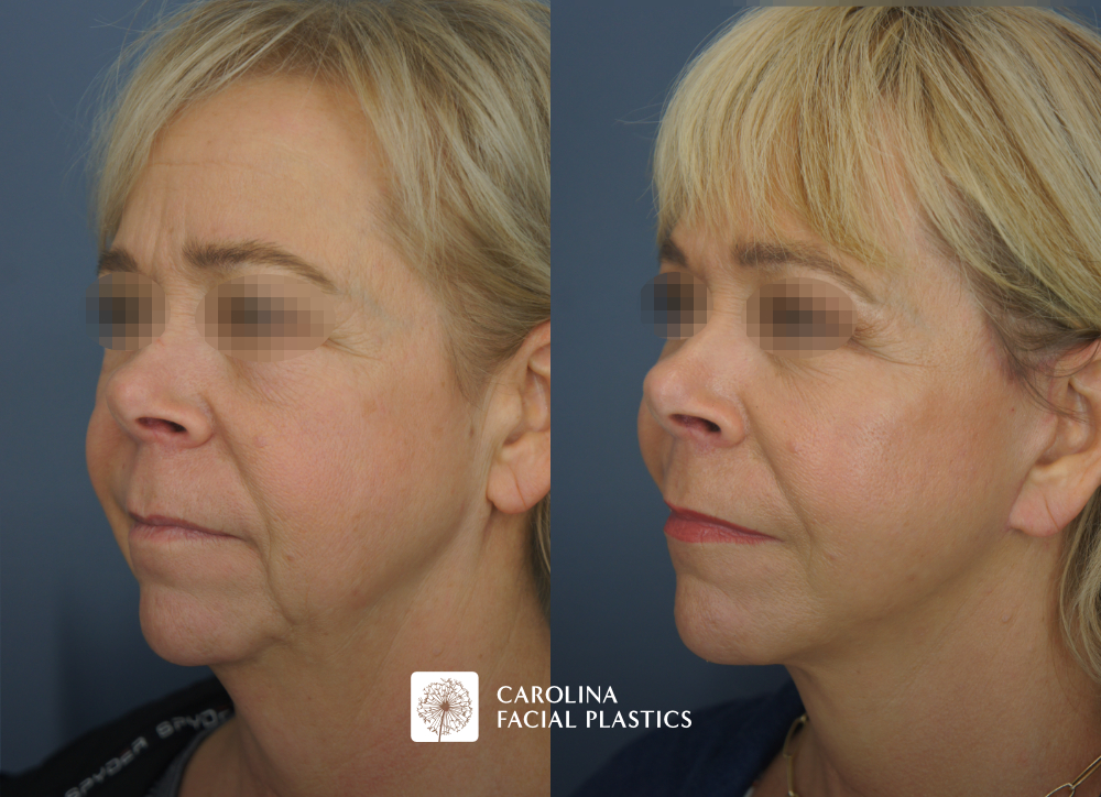 Facelift, Buccal Fat Excision, Lower Blepharoplasty, MLFG to Lower Eyes, CO2 to Lower Eyes, TCA Face by Dr Jonathan Kulbersh | Carolina Facial Plastics