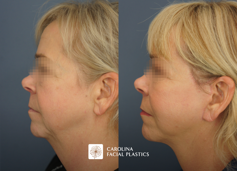 Facelift, Buccal Fat Excision, Lower Blepharoplasty, MLFG to Lower Eyes, CO2 to Lower Eyes, TCA Face by Dr Jonathan Kulbersh | Carolina Facial Plastics