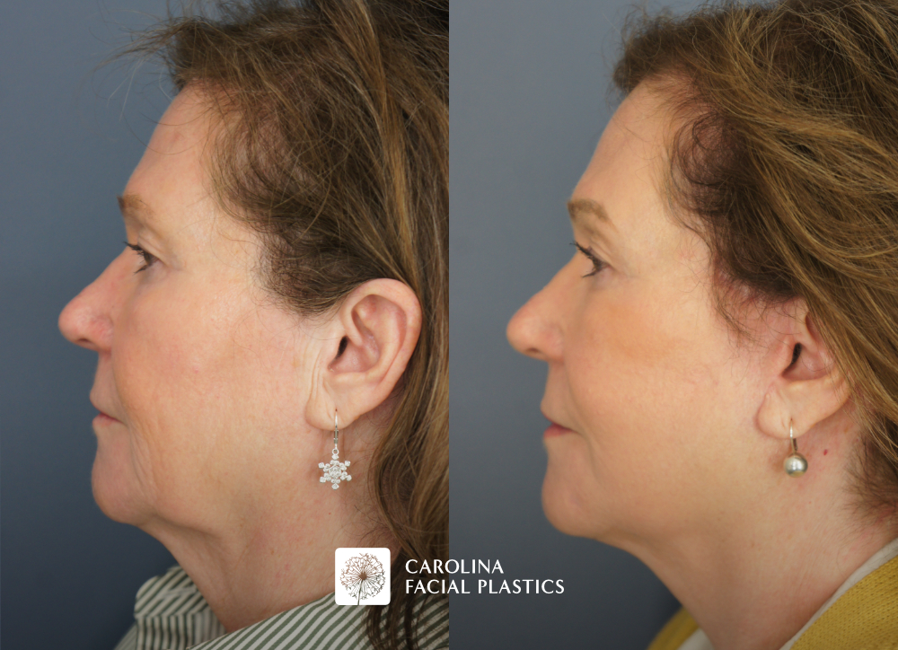 Carolina Facial Plastics - TCA Chemical Peel of the face and neck, by Dr Jonathan Kulbersh