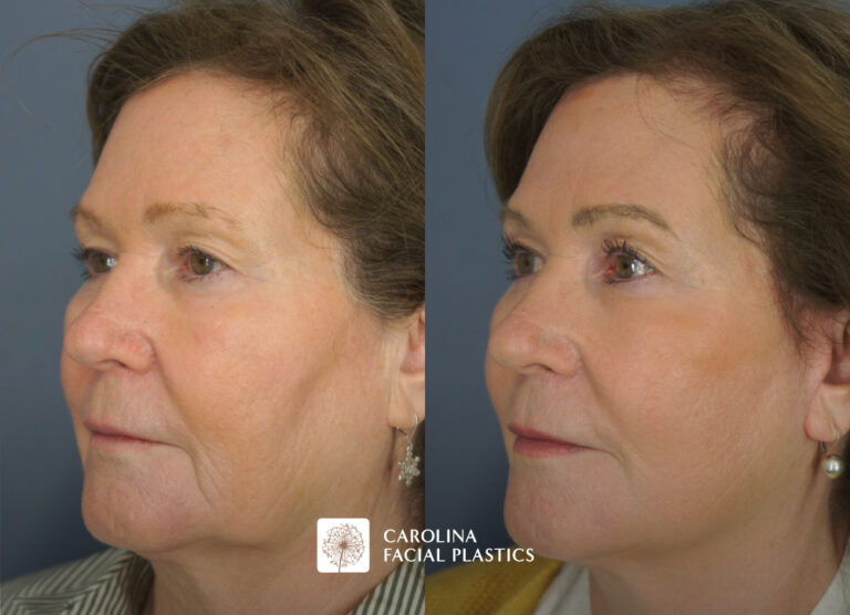Carolina Facial Plastics - TCA Chemical Peel of the face and neck, by Dr Jonathan Kulbersh