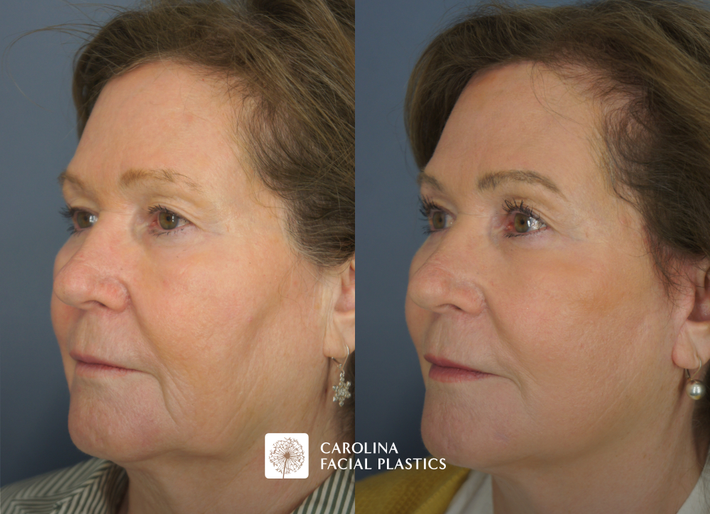 Carolina Facial Plastics - TCA Chemical Peel of the face and neck, by Dr Jonathan Kulbersh