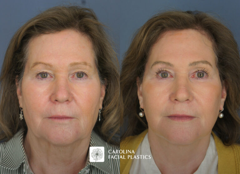 Carolina Facial Plastics - TCA Chemical Peel of the face and neck, by Dr Jonathan Kulbersh