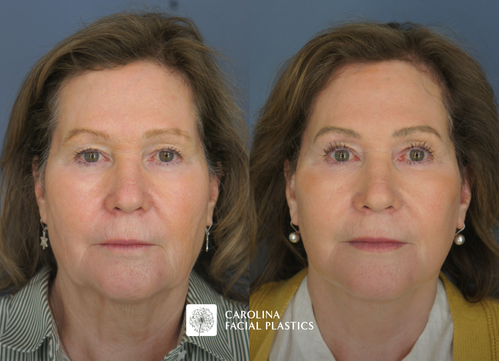 Carolina Facial Plastics - TCA Chemical Peel of the face and neck, by Dr Jonathan Kulbersh