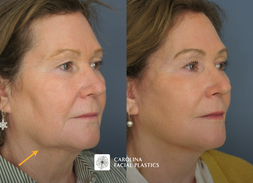 Carolina Facial Plastics - TCA Chemical Peel of the face and neck, by Dr Jonathan Kulbersh