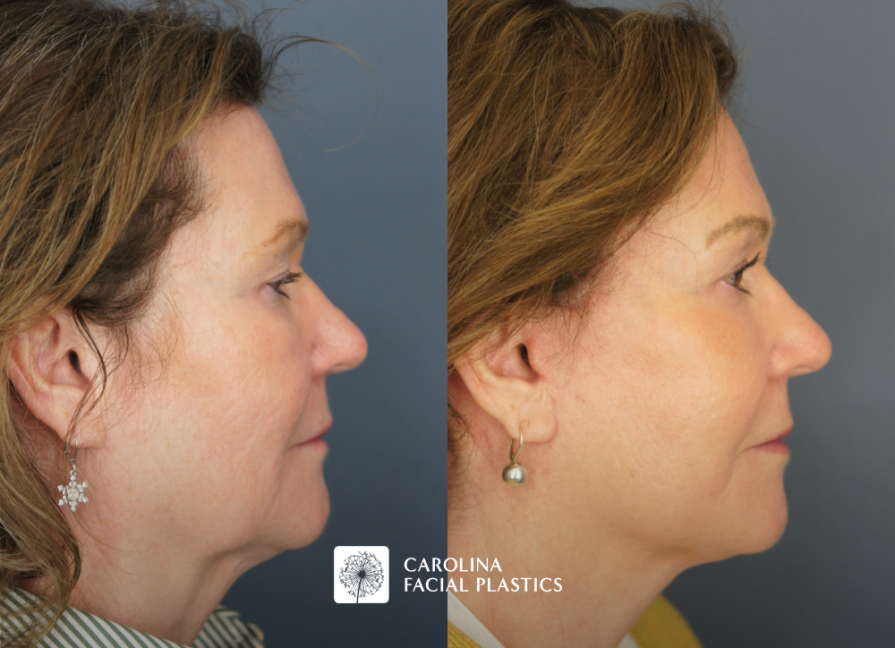 Carolina Facial Plastics - TCA Chemical Peel of the face and neck, by Dr Jonathan Kulbersh