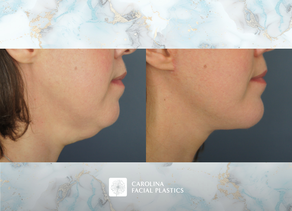 Carolina Facial Plastics - Facelift with Platysmaplasty and Chin Implant, by Dr Jonathan Kulbersh