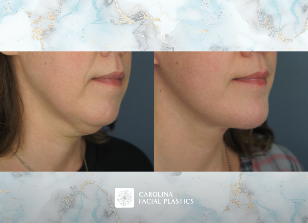 Carolina Facial Plastics - Facelift with Platysmaplasty and Chin Implant, by Dr Jonathan Kulbersh