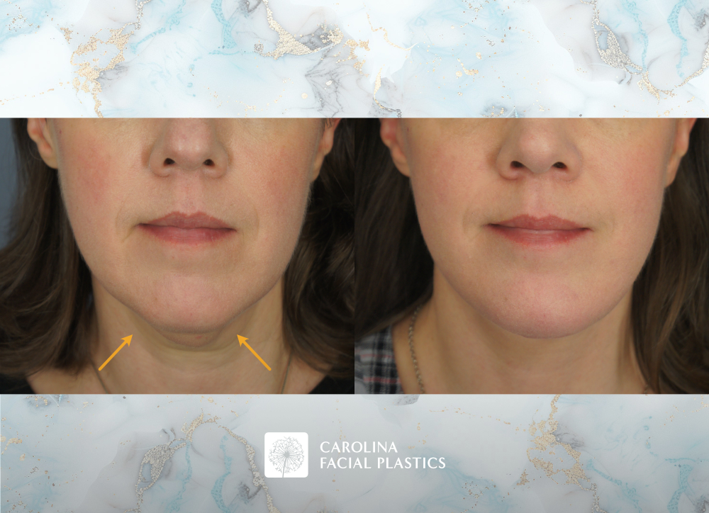 Carolina Facial Plastics - Facelift with Platysmaplasty and Chin Implant, by Dr Jonathan Kulbersh