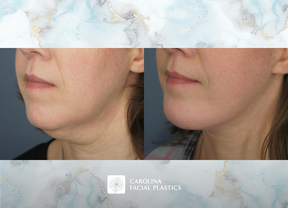 Carolina Facial Plastics - Facelift with Platysmaplasty and Chin Implant, by Dr Jonathan Kulbersh