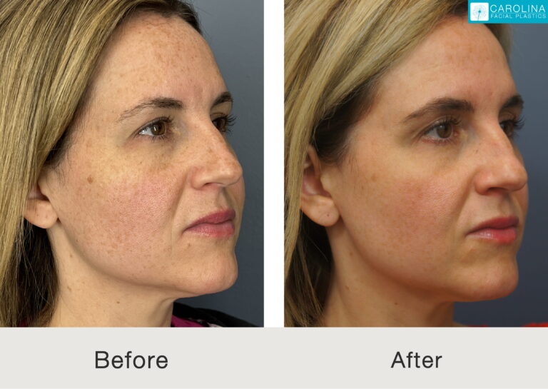 Female patient before and after treatment for skin texture and pores in charlotte.