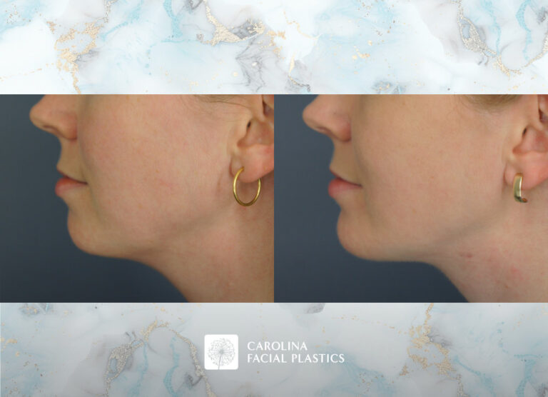 Carolina Facial Plastics | Chin Implant by Dr Jonathan Kulbersh