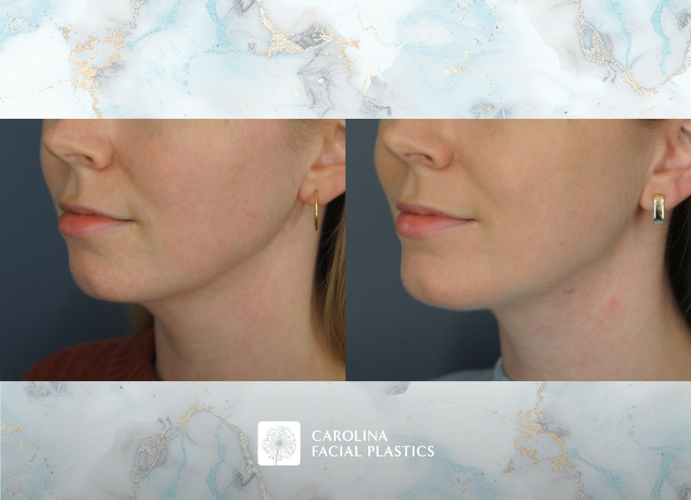 Carolina Facial Plastics | Chin Implant by Dr Jonathan Kulbersh