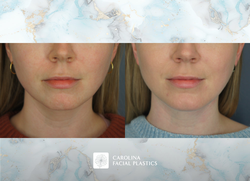 Carolina Facial Plastics | Chin Implant by Dr Jonathan Kulbersh