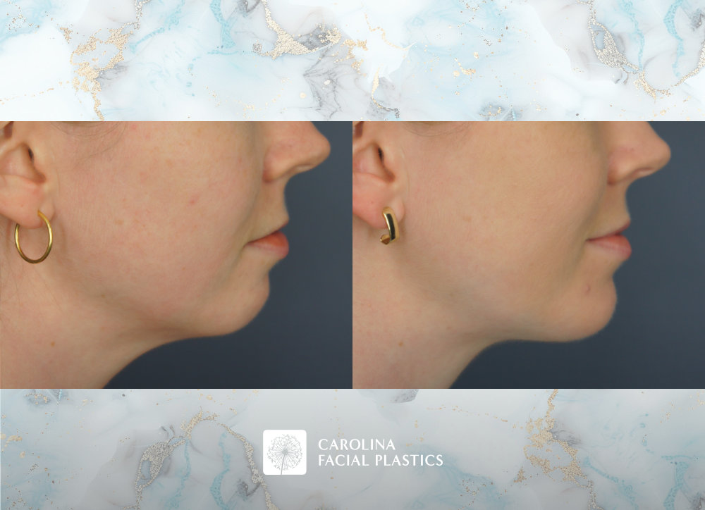 Carolina Facial Plastics | Chin Implant by Dr Jonathan Kulbersh
