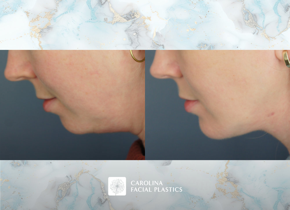 Carolina Facial Plastics | Chin Implant by Dr Jonathan Kulbersh