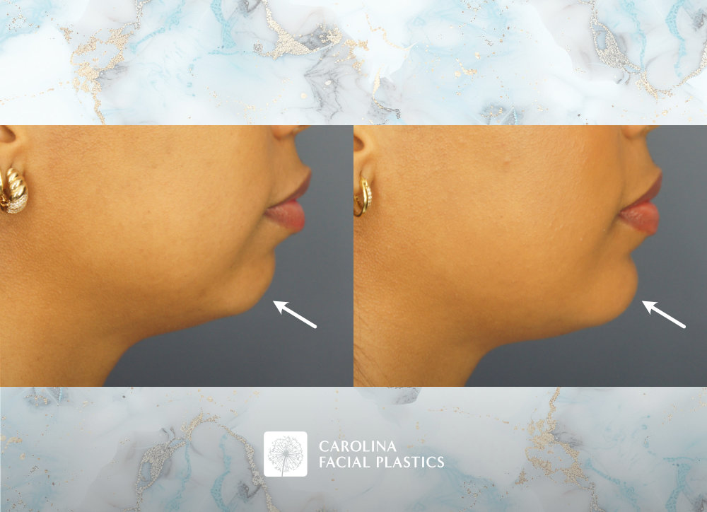Carolina Facial Plastics - Chin Implant by Dr Jonathan Kulbersh