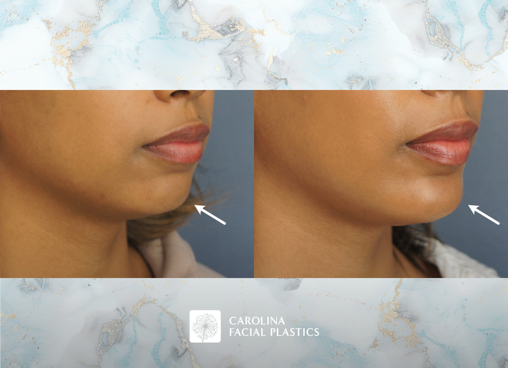 Carolina Facial Plastics - Chin Implant by Dr Jonathan Kulbersh