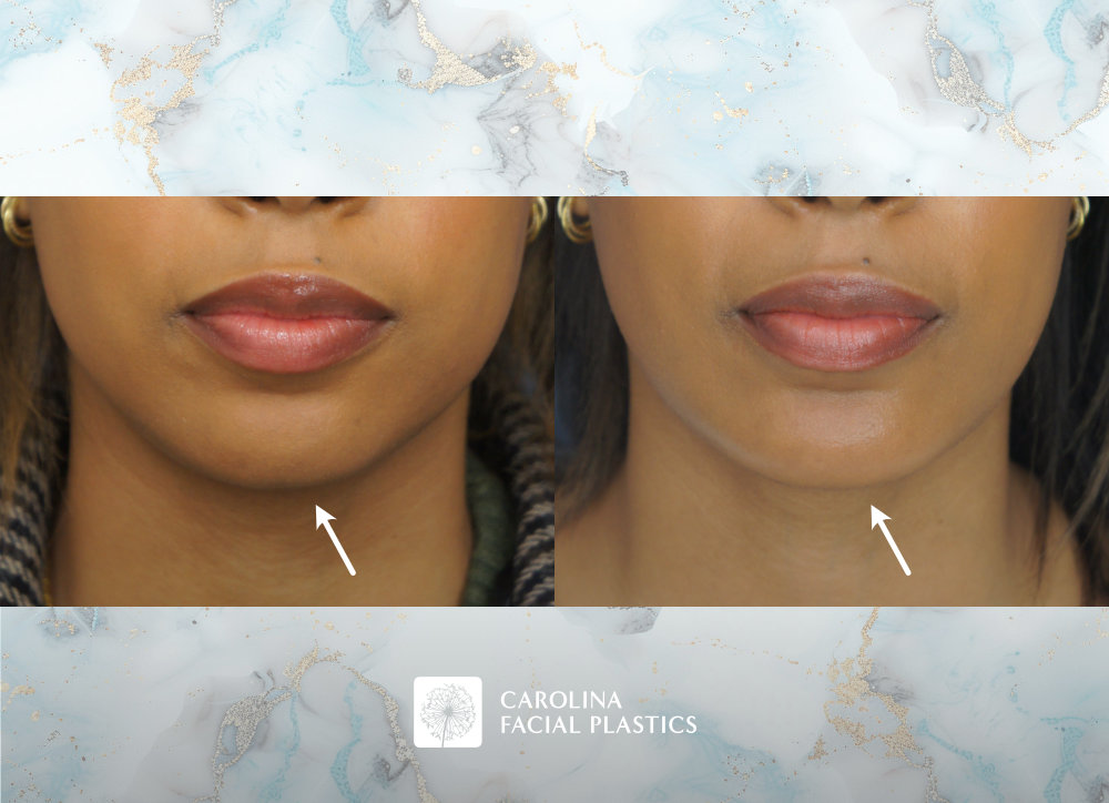 Carolina Facial Plastics - Chin Implant by Dr Jonathan Kulbersh