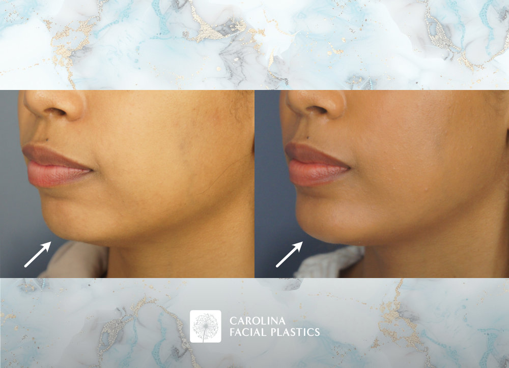 Carolina Facial Plastics - Chin Implant by Dr Jonathan Kulbersh