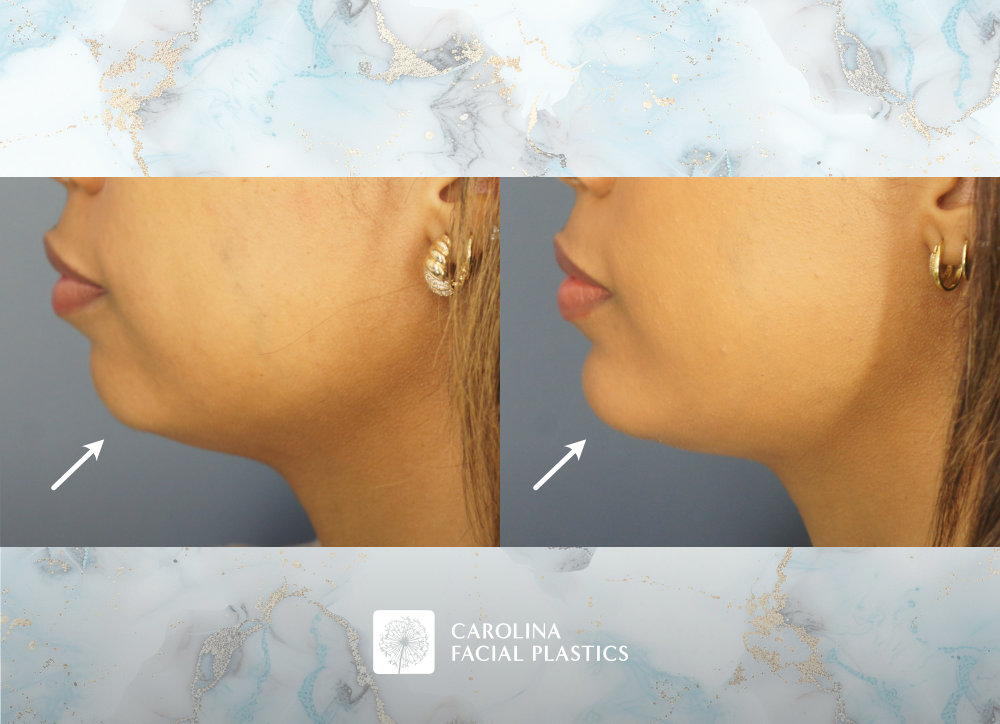Carolina Facial Plastics - Chin Implant by Dr Jonathan Kulbersh