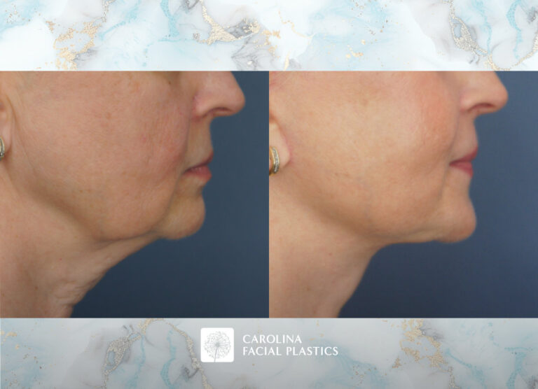 Carolina Facial Plastics - Facelift, Bilateral Lower Blepharoplasty, Endoscopic Brow Lift, and Fat Grafting to Lower Eyes and Chin by Dr Jonathan Kulbersh