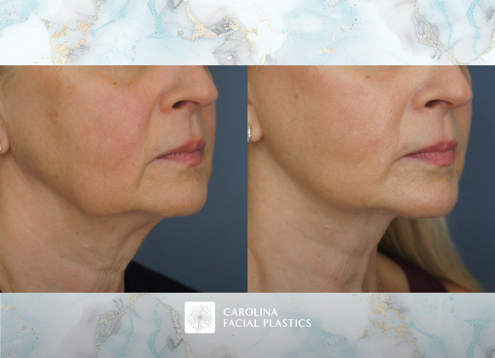 Carolina Facial Plastics - Facelift, Bilateral Lower Blepharoplasty, Endoscopic Brow Lift, and Fat Grafting to Lower Eyes and Chin by Dr Jonathan Kulbersh