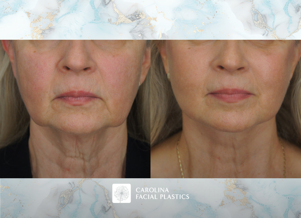 Carolina Facial Plastics - Facelift, Bilateral Lower Blepharoplasty, Endoscopic Brow Lift, and Fat Grafting to Lower Eyes and Chin by Dr Jonathan Kulbersh